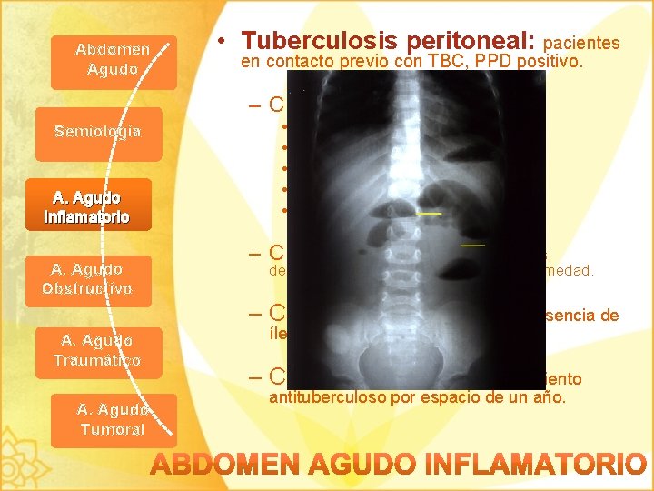 Abdomen Agudo • Tuberculosis peritoneal: pacientes en contacto previo con TBC, PPD positivo. –