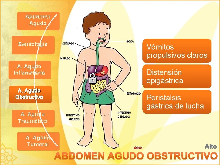 Abdomen Agudo Semiología A. Agudo Inflamatorio A. Agudo Obstructivo Vómitos propulsivos claros Distensión epigástrica