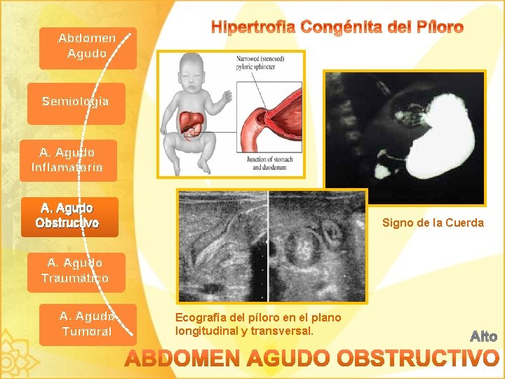 Abdomen Agudo Semiología A. Agudo Inflamatorio A. Agudo Obstructivo Signo de la Cuerda A.