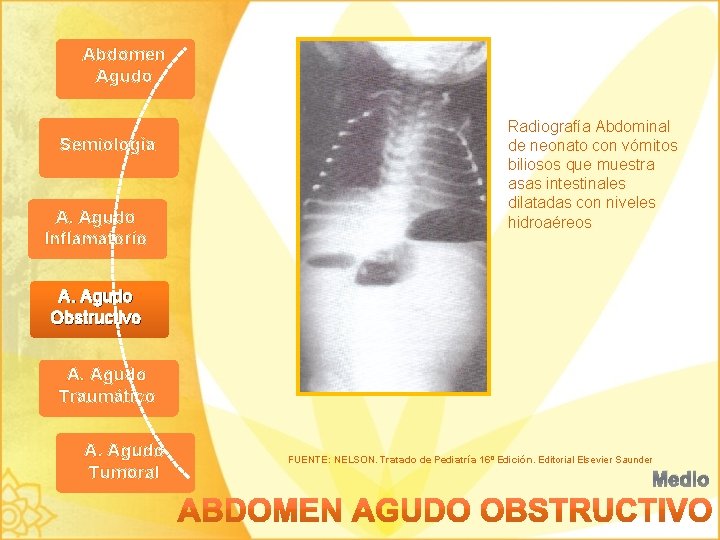 Abdomen Agudo Semiología A. Agudo Inflamatorio Radiografía Abdominal de neonato con vómitos biliosos que