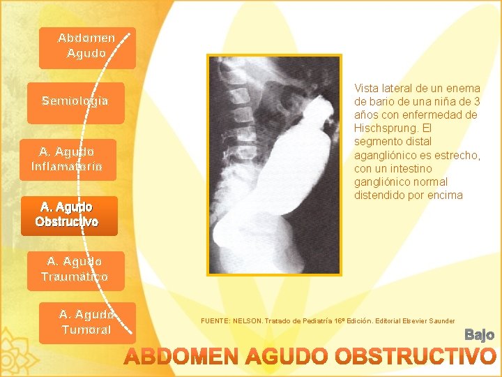 Abdomen Agudo Semiología A. Agudo Inflamatorio A. Agudo Obstructivo Vista lateral de un enema