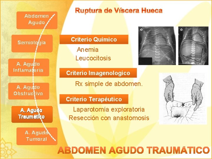 Abdomen Agudo Semiología A. Agudo Inflamatorio A. Agudo Obstructivo A. Agudo Traumático A. Agudo