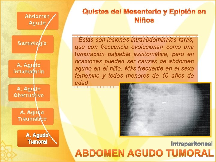 Abdomen Agudo Semiología A. Agudo Inflamatorio A. Agudo Obstructivo Estas son lesiones intraabdominales raras,