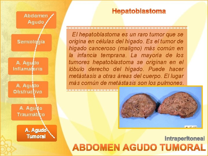 Abdomen Agudo Semiología A. Agudo Inflamatorio A. Agudo Obstructivo El hepatoblastoma es un raro