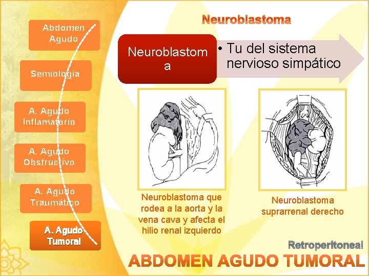 Abdomen Agudo Semiología Neuroblastom • Tu del sistema nervioso simpático a A. Agudo Inflamatorio