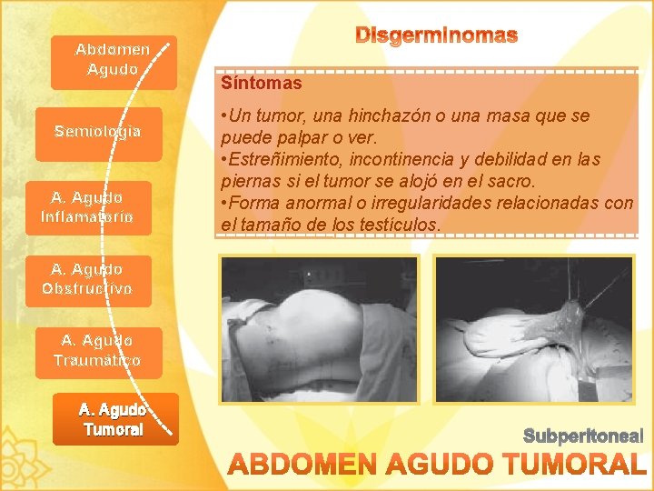 Abdomen Agudo Semiología A. Agudo Inflamatorio Síntomas • Un tumor, una hinchazón o una