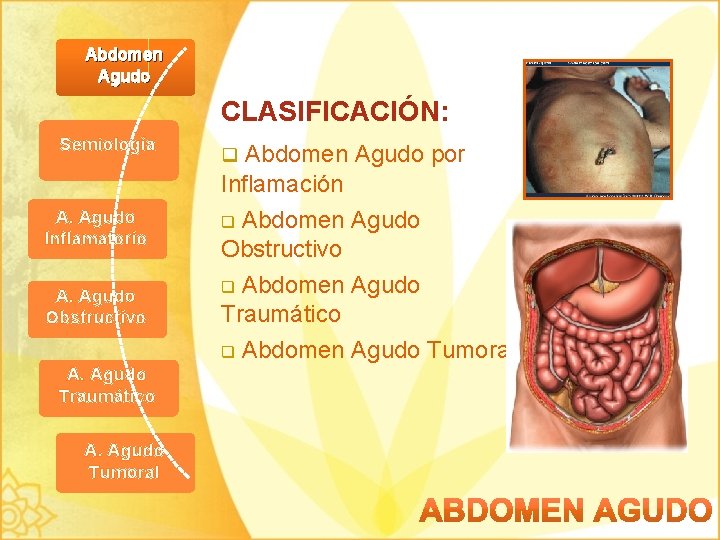 Abdomen Agudo Semiología CLASIFICACIÓN: q Abdomen Agudo por Inflamación Abdomen Agudo Obstructivo A. Agudo