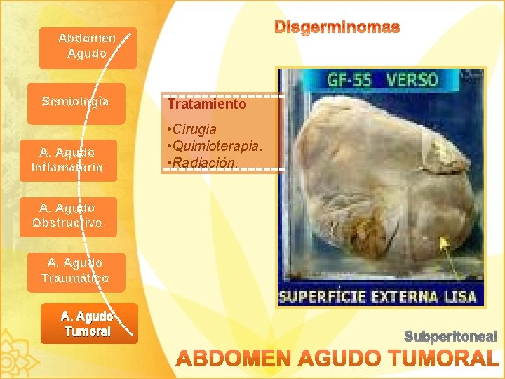 Abdomen Agudo Semiología A. Agudo Inflamatorio Tratamiento • Cirugía • Quimioterapia. • Radiación. A.