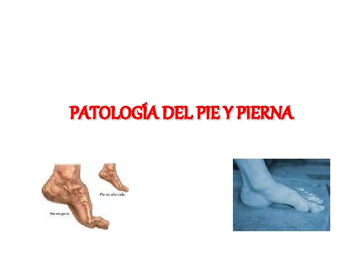 PATOLOGÍA DEL PIE Y PIERNA 