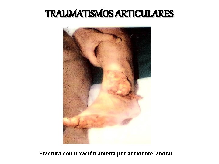 TRAUMATISMOS ARTICULARES Fractura con luxación abierta por accidente laboral 