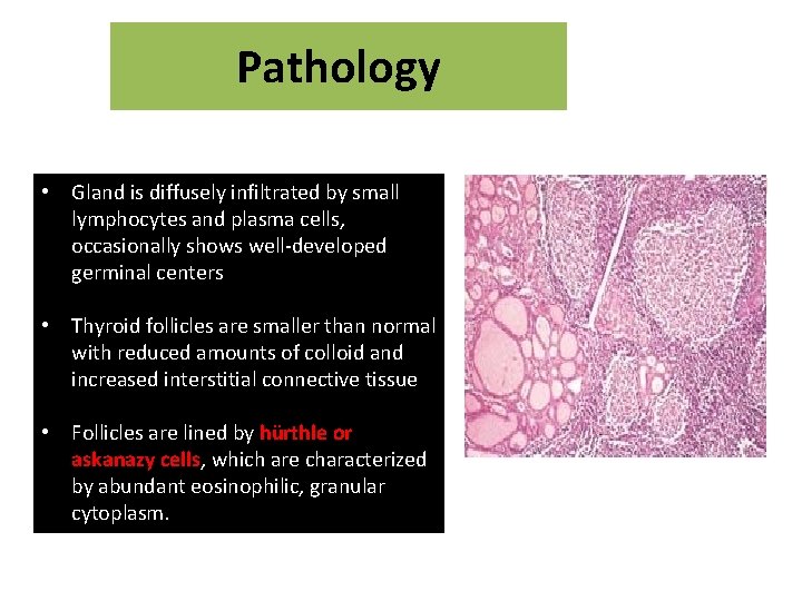 Pathology • Gland is diffusely infiltrated by small lymphocytes and plasma cells, occasionally shows