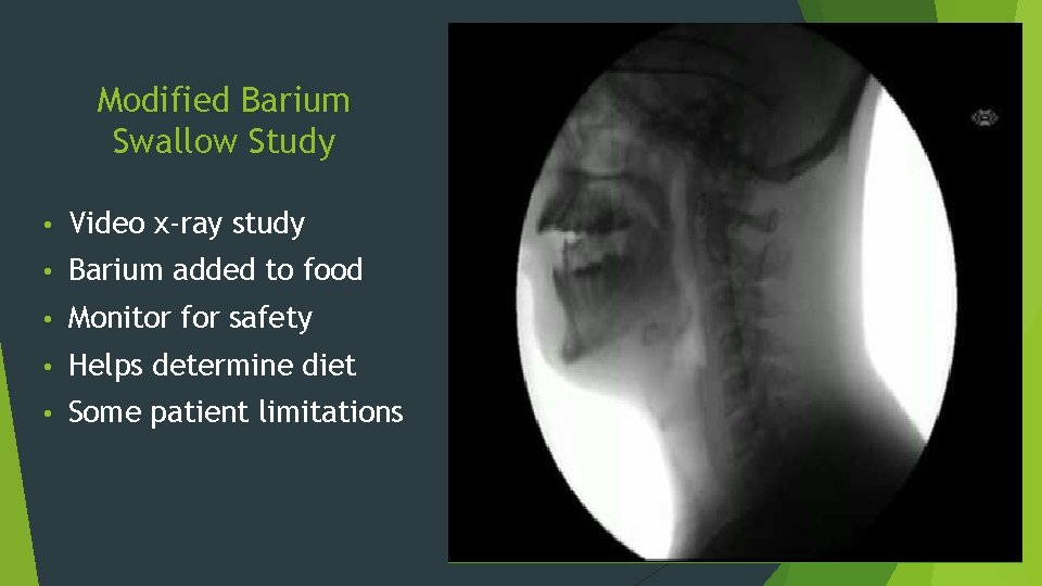 Modified Barium Swallow Study • Video x-ray study • Barium added to food •