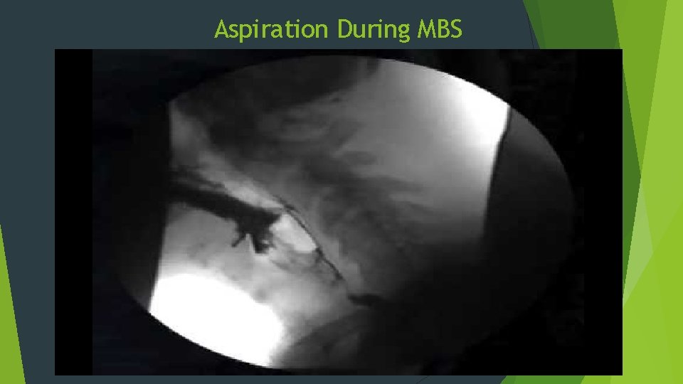 Aspiration During MBS 