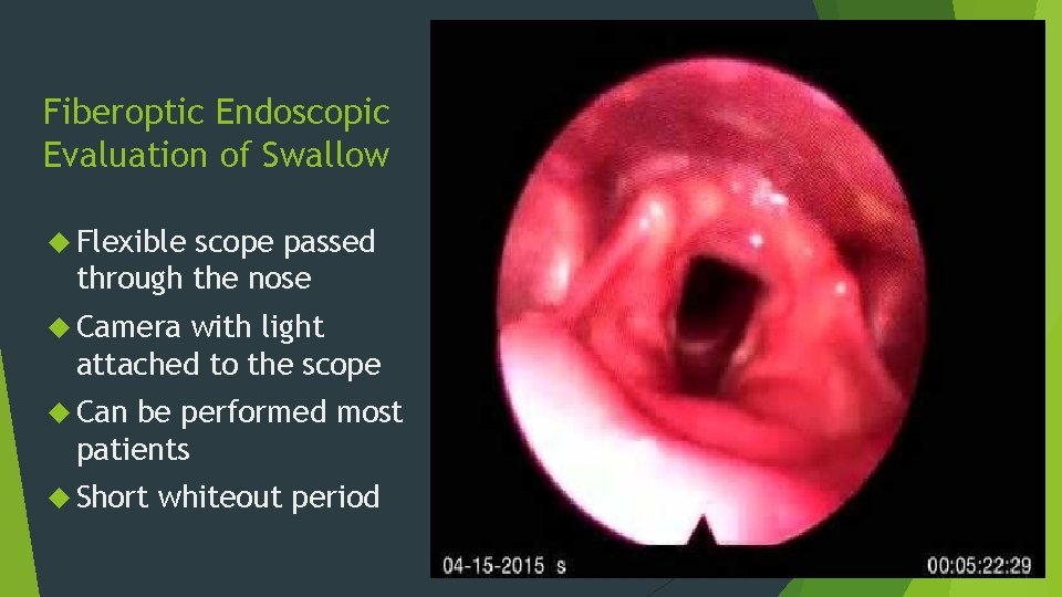 Fiberoptic Endoscopic Evaluation of Swallow Flexible scope passed through the nose Camera with light