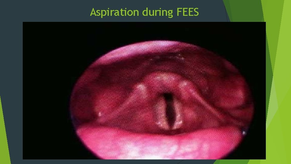 Aspiration during FEES 