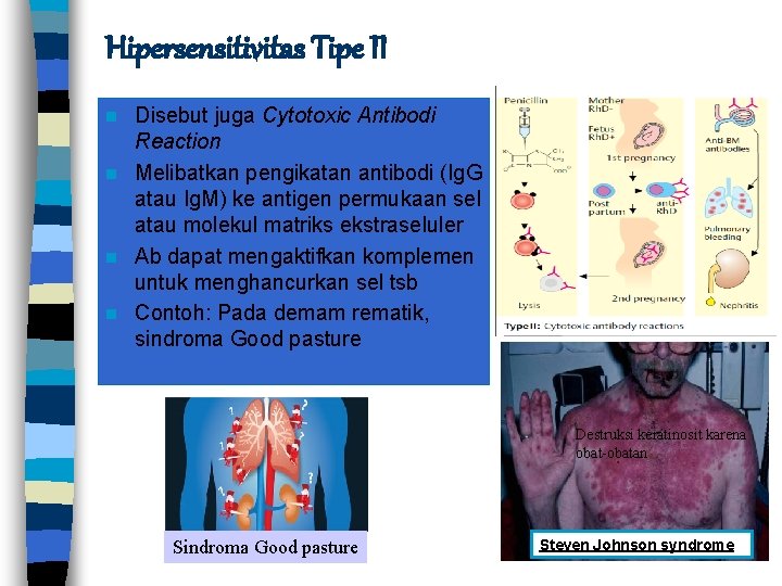 Hipersensitivitas Tipe II Disebut juga Cytotoxic Antibodi Reaction n Melibatkan pengikatan antibodi (Ig. G