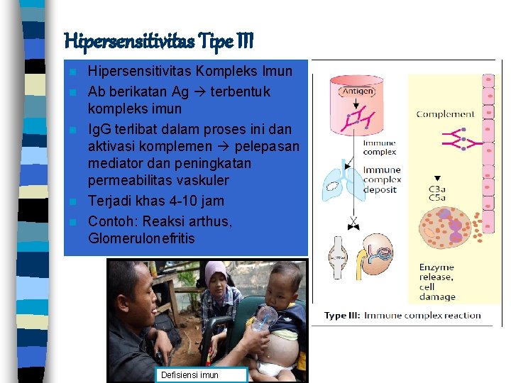 Hipersensitivitas Tipe III n n n Hipersensitivitas Kompleks Imun Ab berikatan Ag terbentuk kompleks