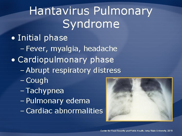 Hantavirus Pulmonary Syndrome • Initial phase – Fever, myalgia, headache • Cardiopulmonary phase –