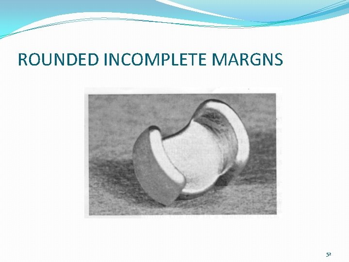 ROUNDED INCOMPLETE MARGNS 52 