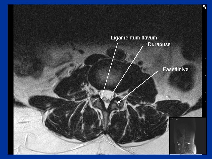 Ligamentum flavum Durapussi Fasettinivel 