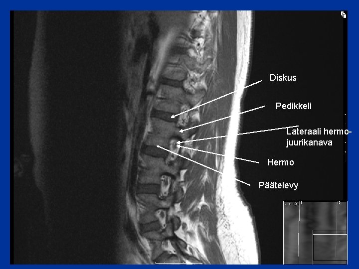 Diskus Pedikkeli Lateraali hermojuurikanava Hermo Päätelevy 