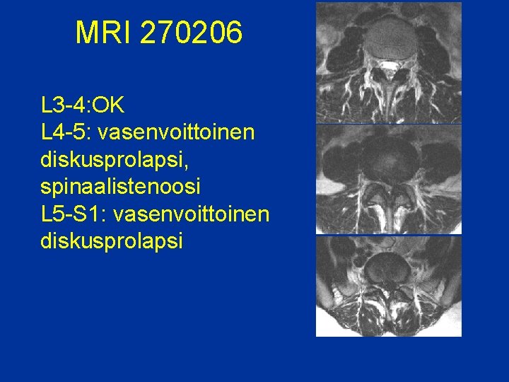MRI 270206 L 3 -4: OK L 4 -5: vasenvoittoinen diskusprolapsi, spinaalistenoosi L 5