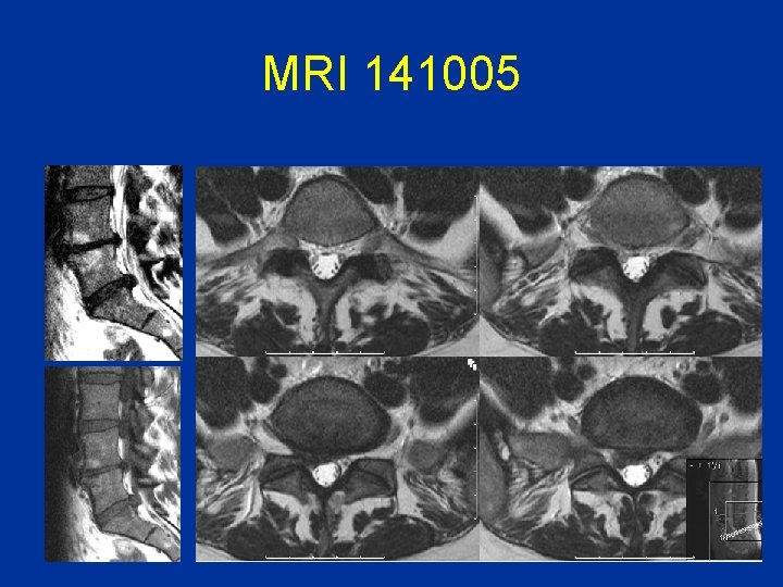 MRI 141005 