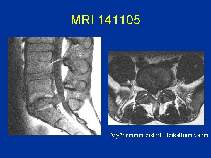 MRI 141105 Myöhemmin diskiitti leikattuun väliin 