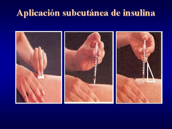 Aplicación subcutánea de insulina 