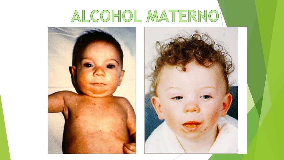 ALCOHOL MATERNO 