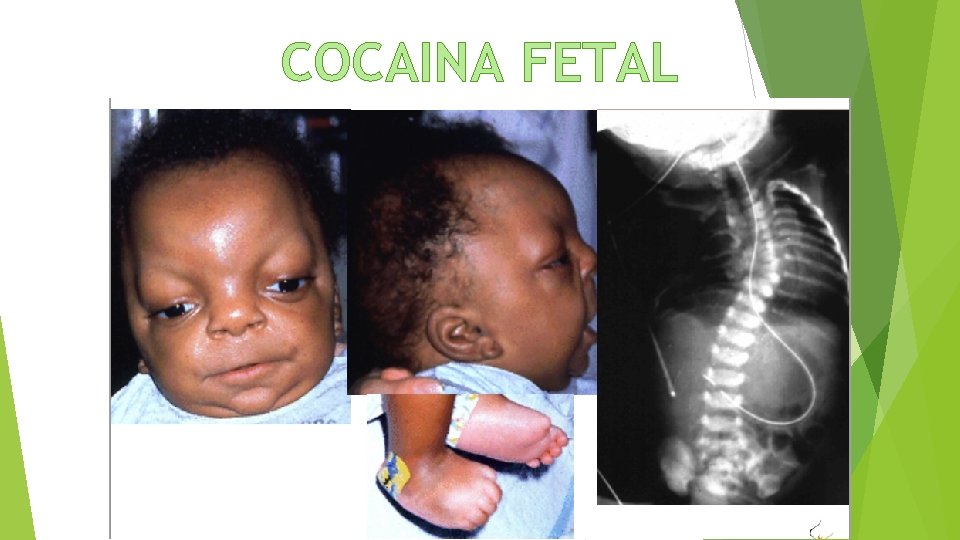 COCAINA FETAL 