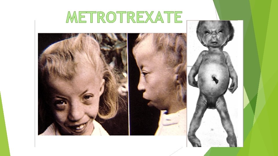 METROTREXATE 