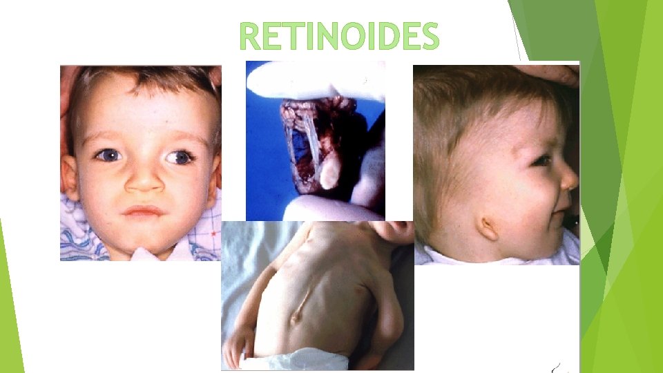 RETINOIDES 