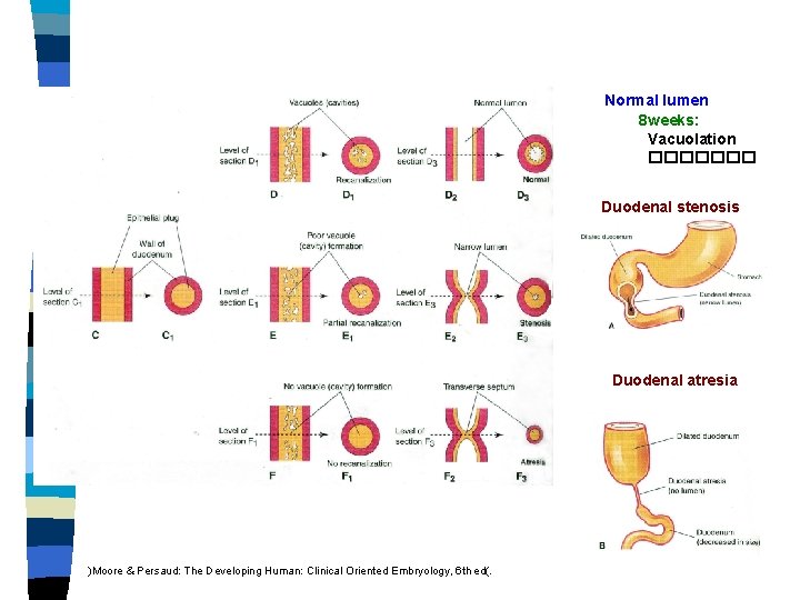 Normal lumen 8 weeks: Vacuolation ������� Duodenal stenosis Duodenal atresia )Moore & Persaud: The