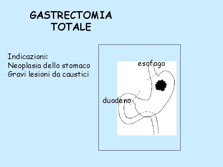 GASTRECTOMIA TOTALE Indicazioni: Neoplasia dello stomaco Gravi lesioni da caustici esofago duodeno 