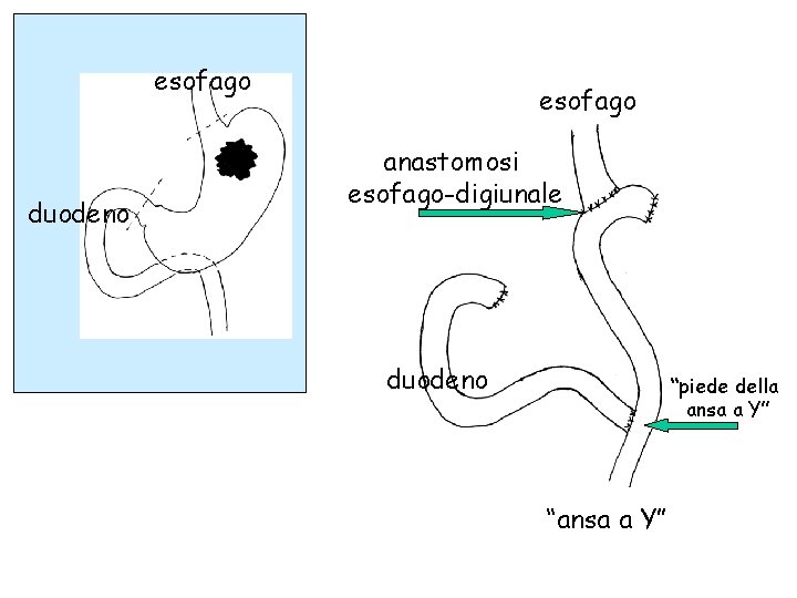 esofago duodeno esofago anastomosi esofago-digiunale duodeno “piede della ansa a Y” “ansa a Y”
