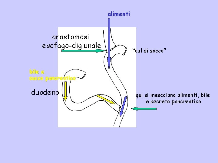 alimenti anastomosi esofago-digiunale “cul di sacco” bile e succo pancreatico duodeno qui si mescolano