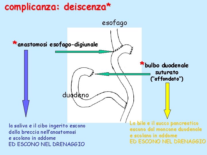 complicanza: deiscenza* esofago * anastomosi esofago-digiunale * bulbo duodenale suturato (“affondato”) duodeno la saliva