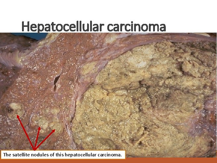 Hepatocellular carcinoma The satellite nodules of this hepatocellular carcinoma. 