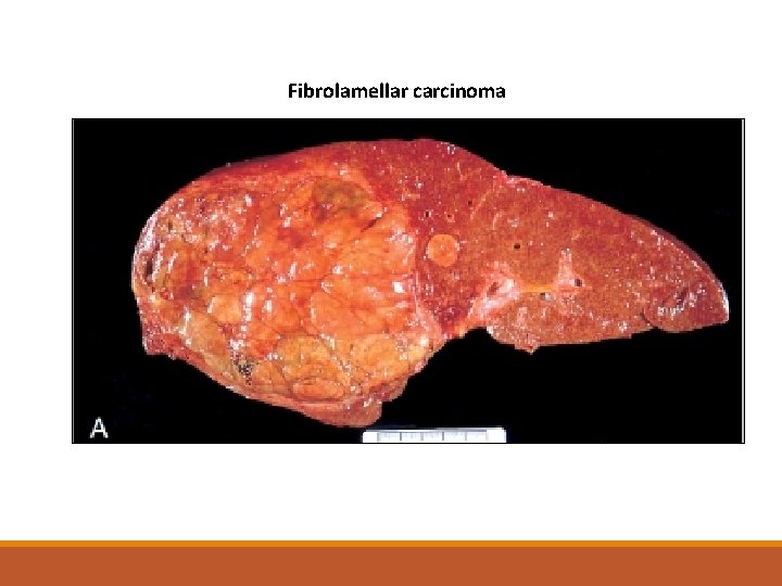 Fibrolamellar carcinoma 