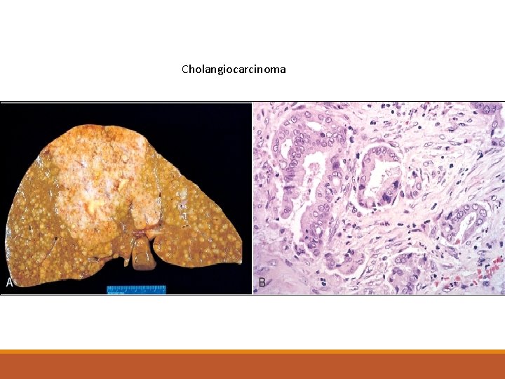 Cholangiocarcinoma 