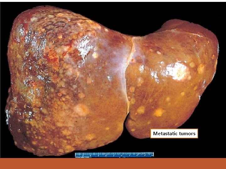 Metastatic tumors 