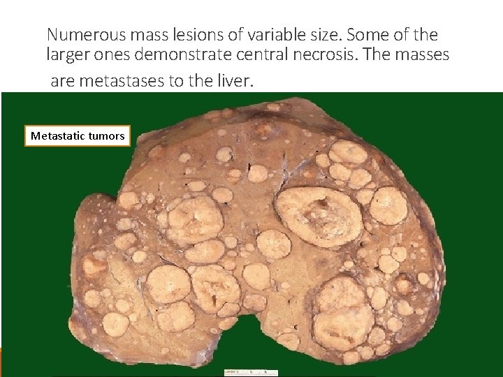 Numerous mass lesions of variable size. Some of the larger ones demonstrate central necrosis.