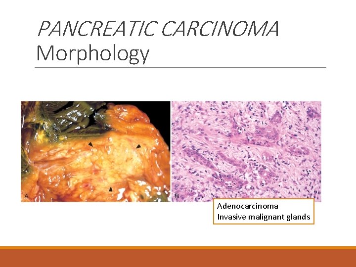 PANCREATIC CARCINOMA Morphology Adenocarcinoma Invasive malignant glands 