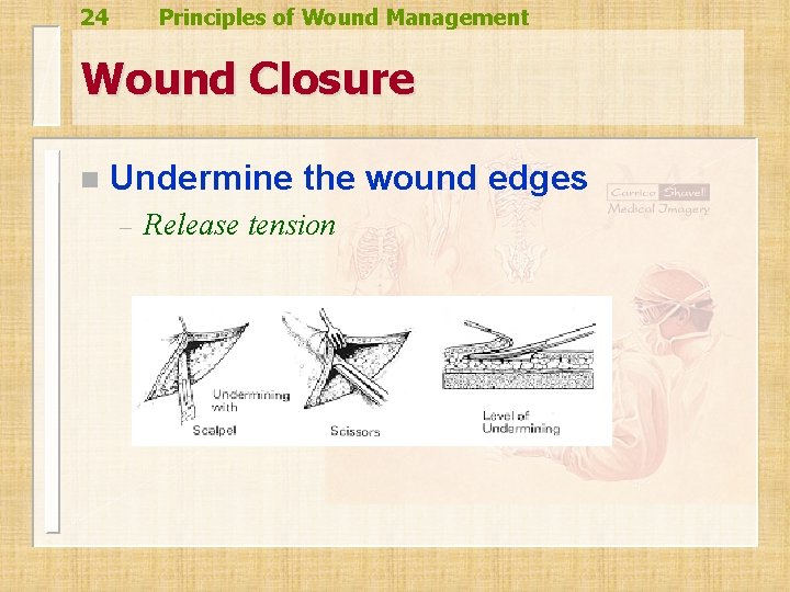 24 Principles of Wound Management Wound Closure n Undermine the wound edges – Release 24 Principles of Wound Management Wound Closure n Undermine the wound edges – Release