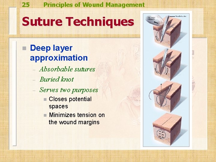 25 Principles of Wound Management Suture Techniques n Deep layer approximation – – – 25 Principles of Wound Management Suture Techniques n Deep layer approximation – – –