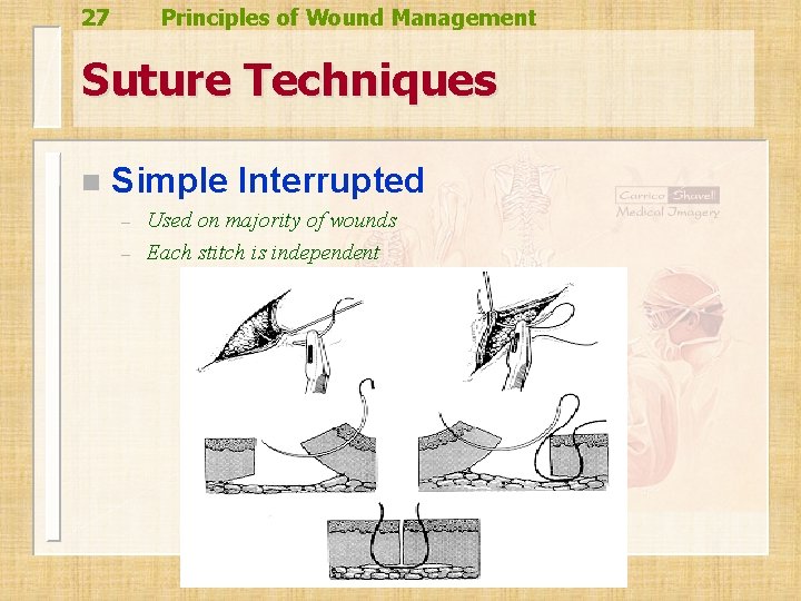 27 Principles of Wound Management Suture Techniques n Simple Interrupted – – Used on 27 Principles of Wound Management Suture Techniques n Simple Interrupted – – Used on
