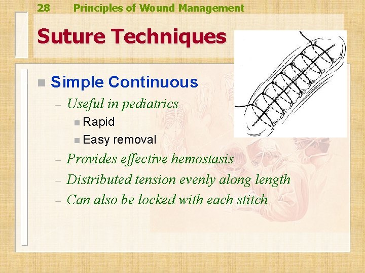 28 Principles of Wound Management Suture Techniques n Simple Continuous – Useful in pediatrics 28 Principles of Wound Management Suture Techniques n Simple Continuous – Useful in pediatrics