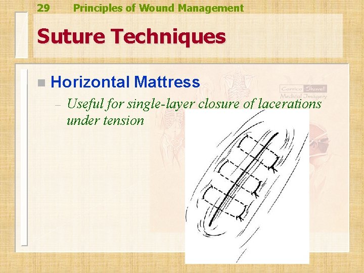 29 Principles of Wound Management Suture Techniques n Horizontal Mattress – Useful for single-layer 29 Principles of Wound Management Suture Techniques n Horizontal Mattress – Useful for single-layer