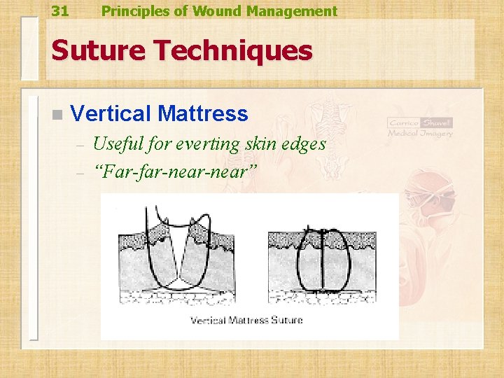 31 Principles of Wound Management Suture Techniques n Vertical Mattress – – Useful for 31 Principles of Wound Management Suture Techniques n Vertical Mattress – – Useful for
